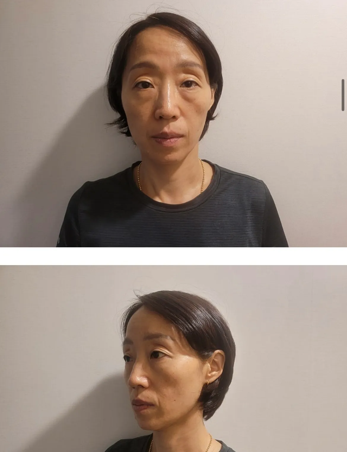 지방이식 레전드