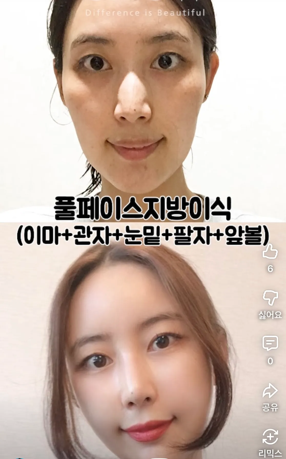 지방이식 레전드3