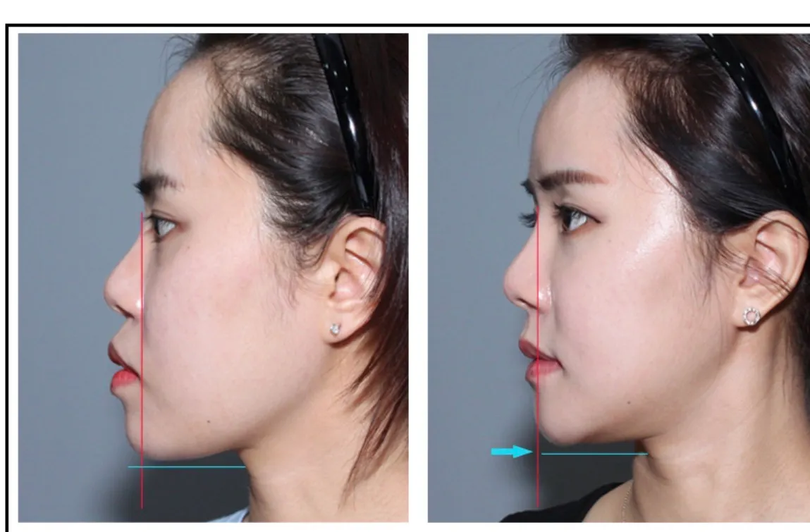 저 양악필수 얼굴이였는데 이렇게생겼어요2