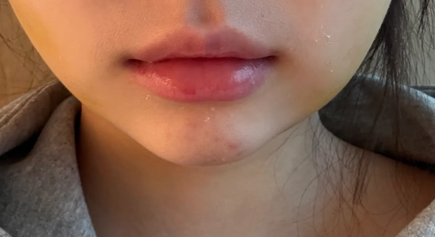 입술필러 다시 맞아야될까요?