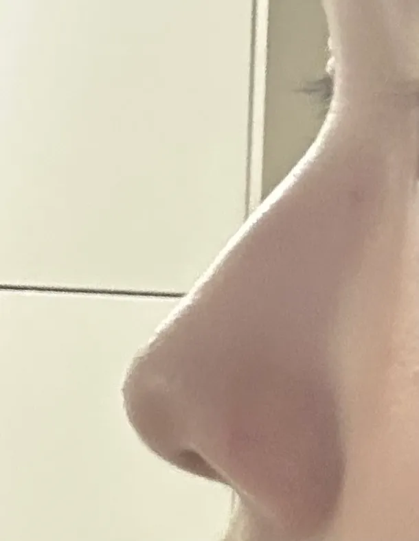 이정도 매부리 수술할까요?