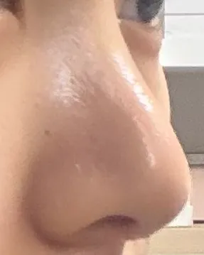 언니들 저 코수술 3주찬데