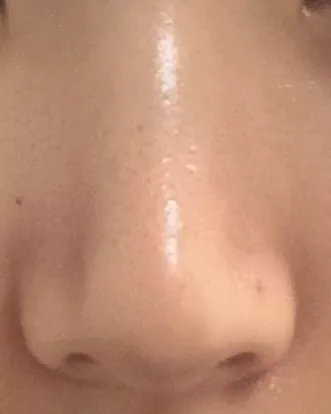 언니들 저 코수술 3주찬데3