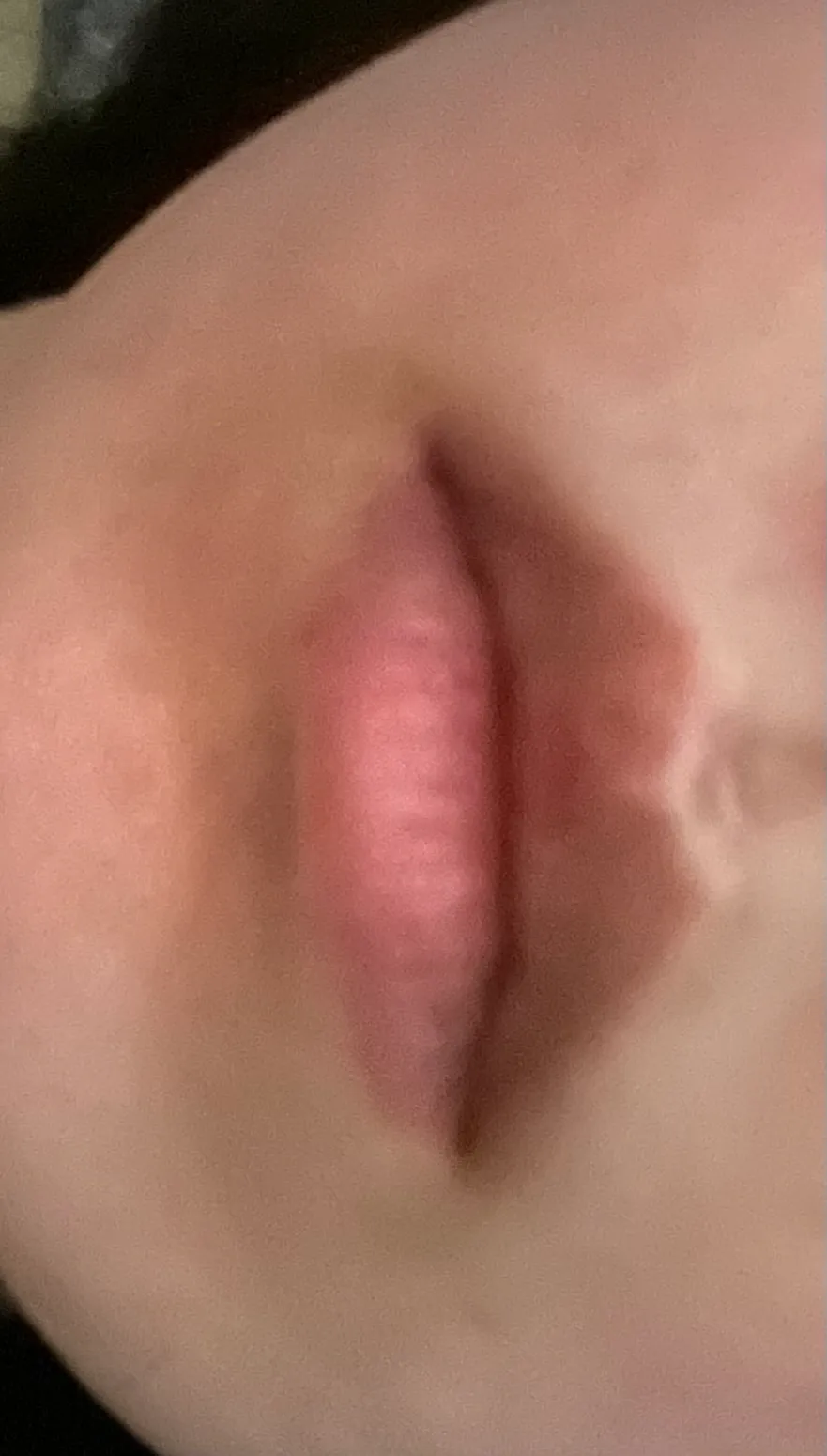 입꼬리필러만 할까용