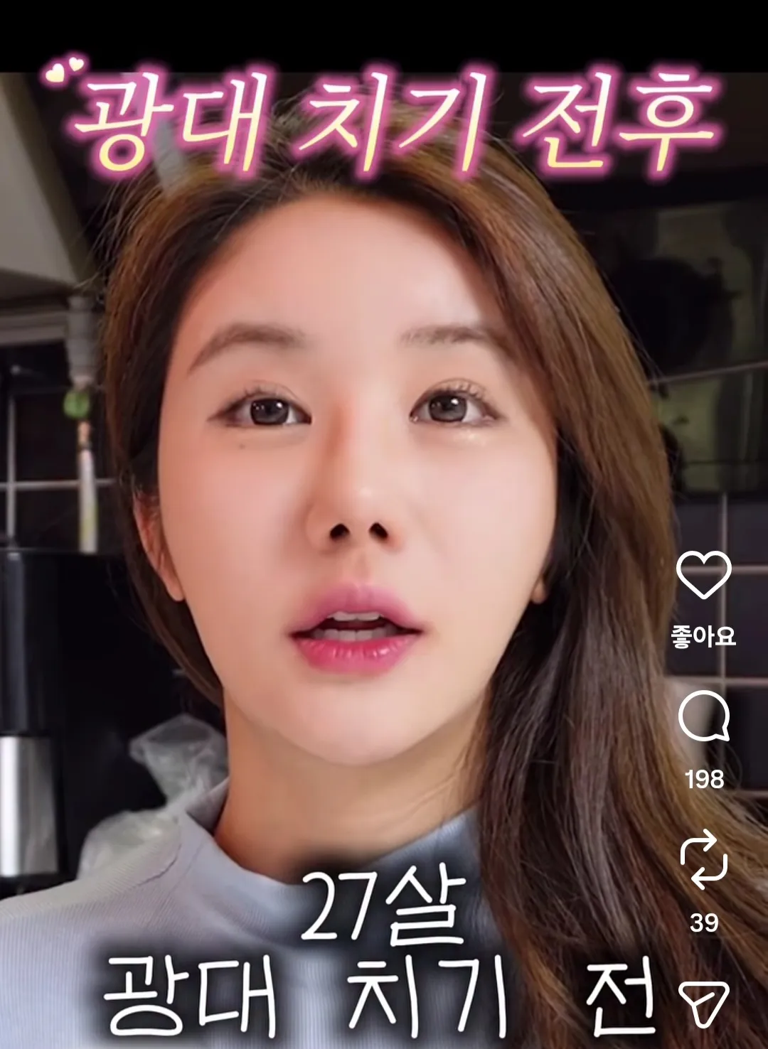 이분 광대 친게 나아요 안 친게 나아욤?