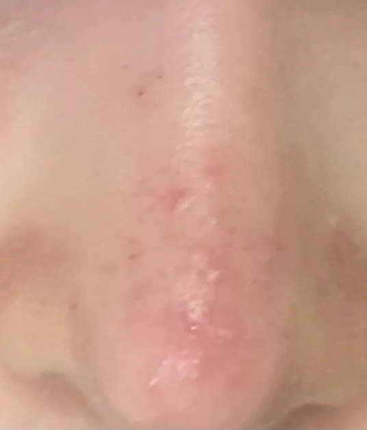 피부 어덕햐요ㅠㅜ2