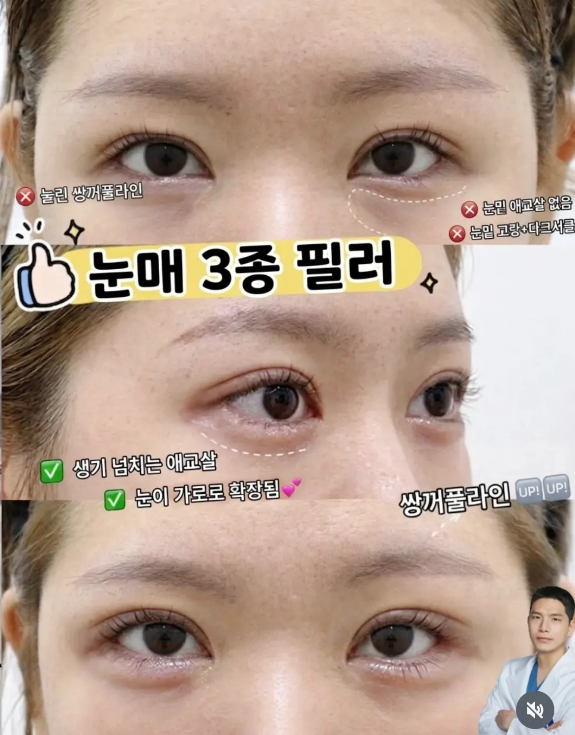 쌍카풀필러