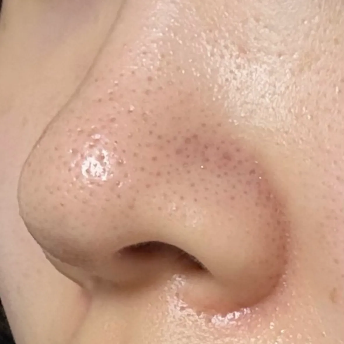 콧볼부각?어케없애요ㅜ2