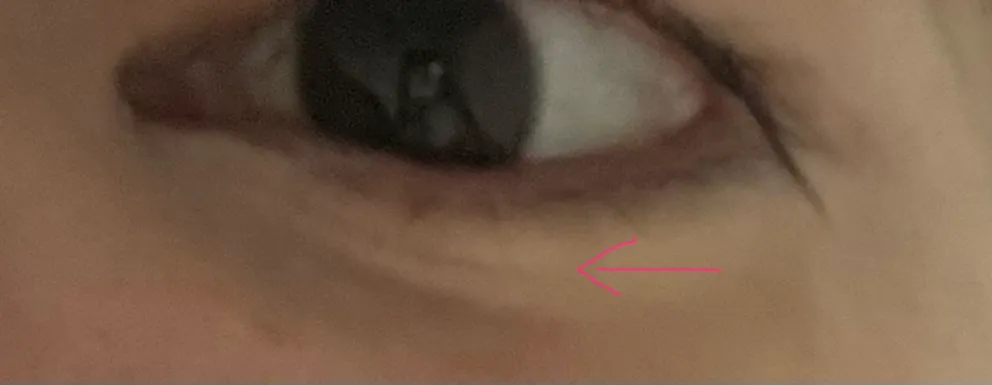 눈밑에 주름? 때문에 애교필러