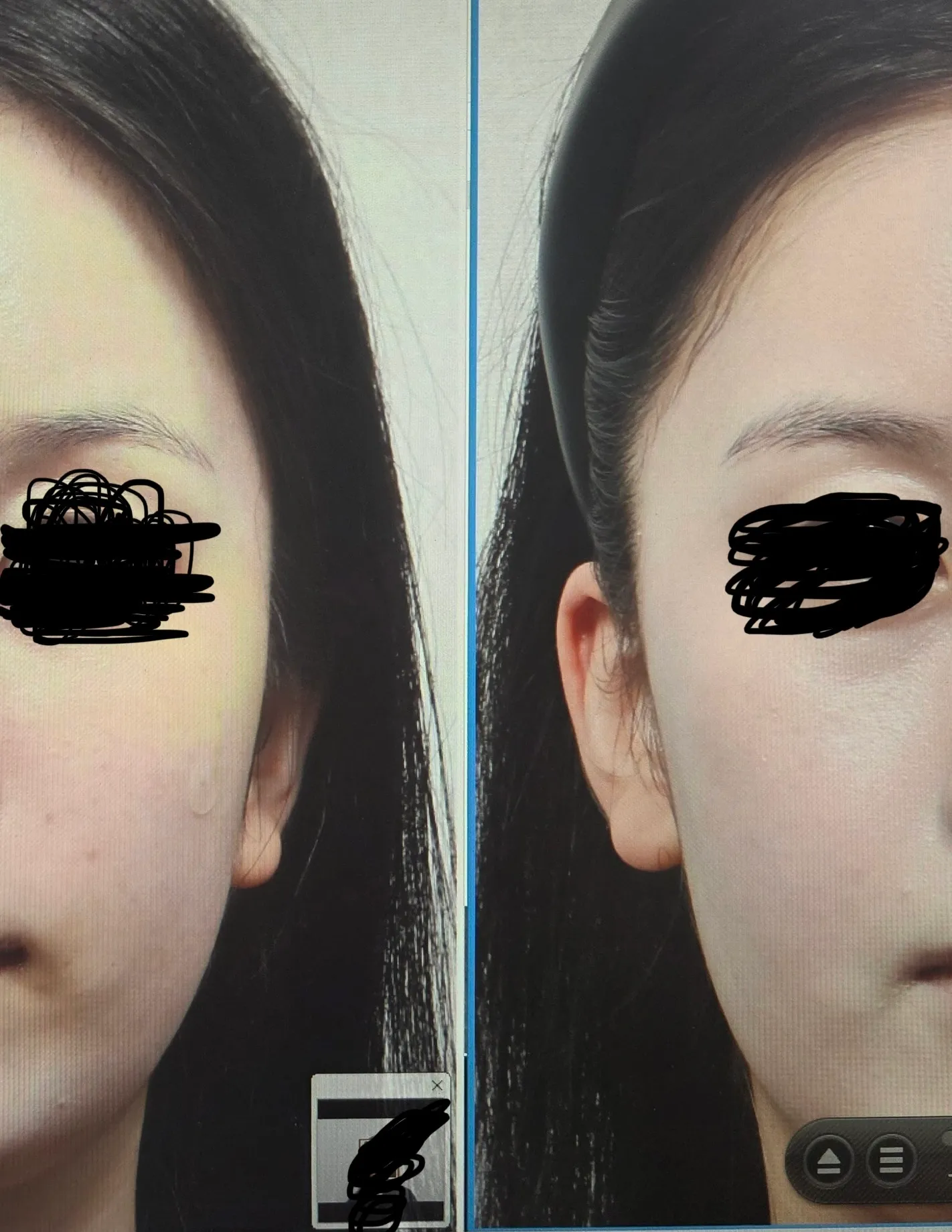 20살은 시술 ㄹㅇ 아무걸도 안하는게나아요? 댓글