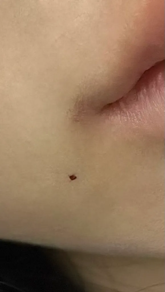 언니들 입꼬리 보톡스 위치가 여기 맞아요?