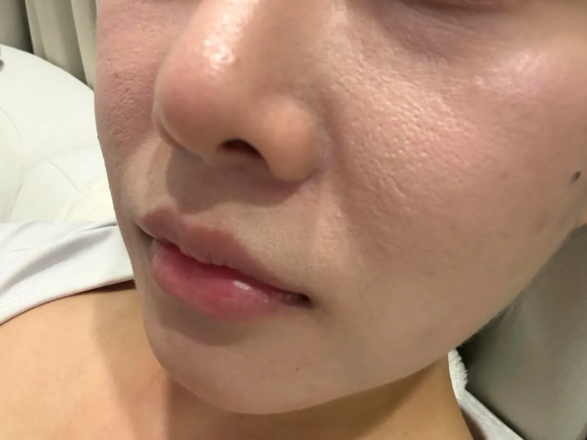 언니들 스킨보톡스 뭐맞아요?