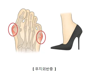 무지외반증인가 ㅜㅜ