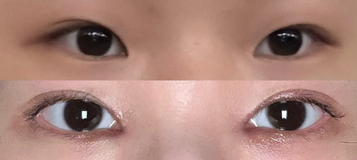 눈성형 전후 봐주세용