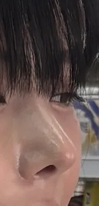 코에 살붙은건지 변형된건지 봐주세여