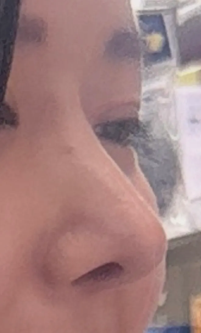 코에 살붙은건지 변형된건지 봐주세여2