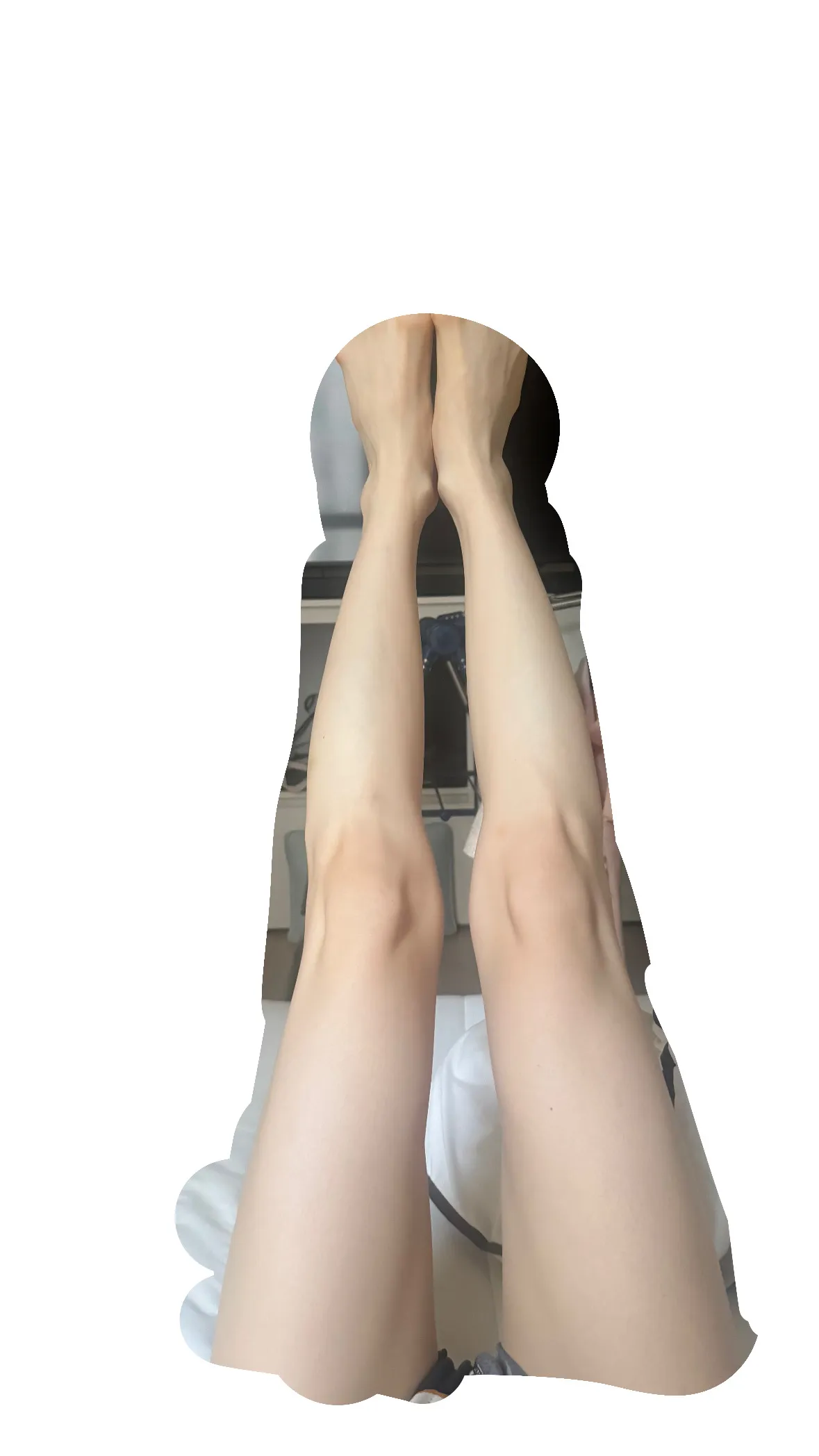 종아리 보톡스 +셀컷주사 10일차후기2