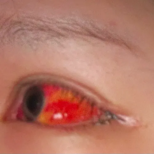 언니들 혐짤 ㅈㅅ요근데 결막부종 원래 이케 심한가요
