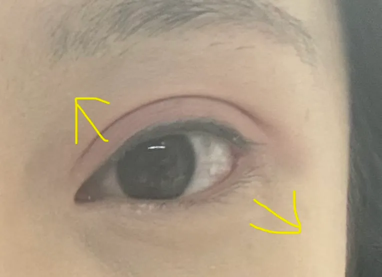 여기 눈올리는 수술은 뭐해야하나요ㅠ?