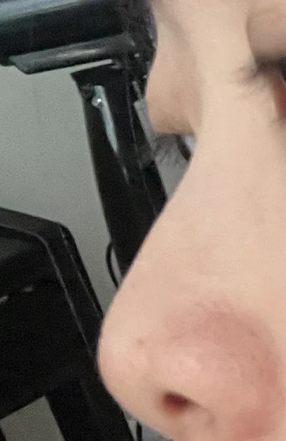코 부작용 오는게 너무 무서워서