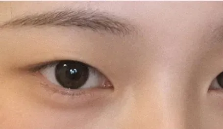 언니들 이런 눈이면 쌍수 하나여?..