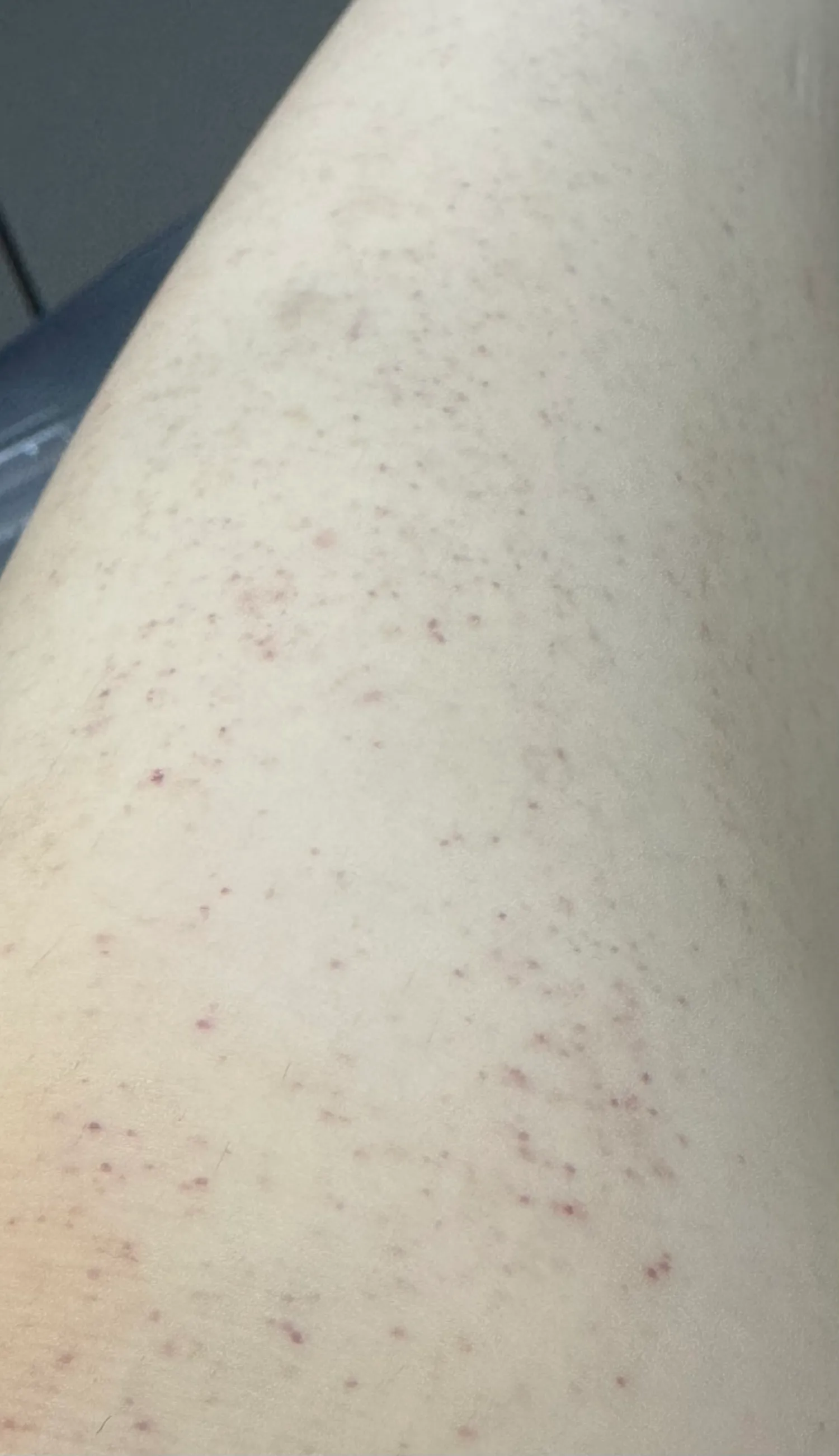 (혐주의)다리에 반점..?같은게낫어요ㅠㅠ