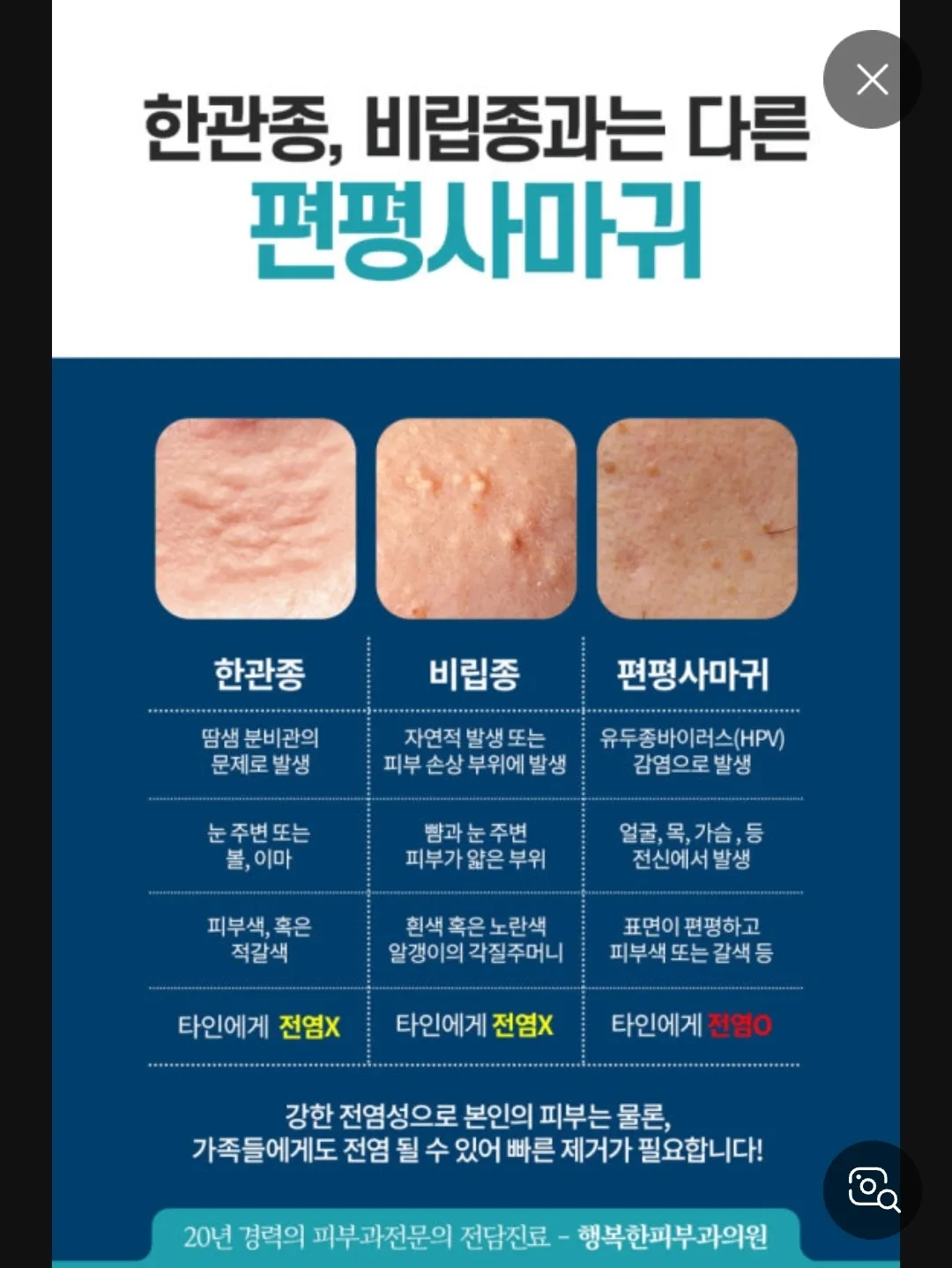 아아악!!!편평사마귀 원인이 HPV자이러스래요. 댓글