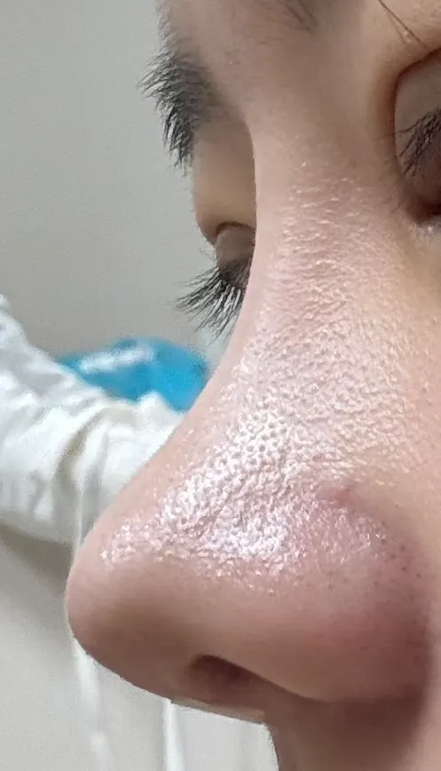 코가 ㅈㄴ 뾰족하게됐어요 시...이...발...