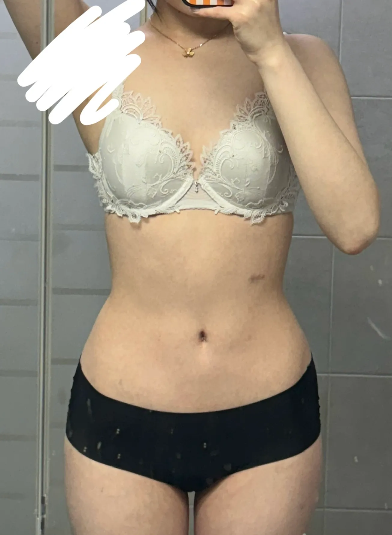 저 2시간 후에 상체지방흡입해요