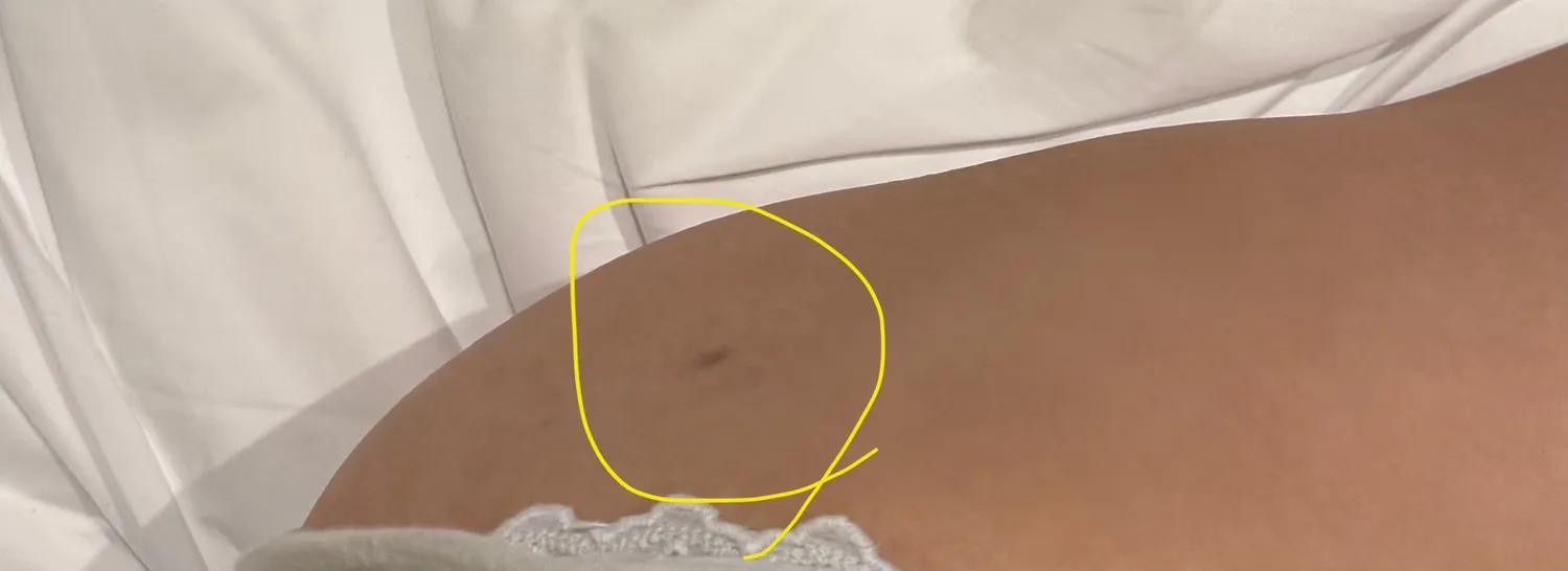 지흡흉터 레이저