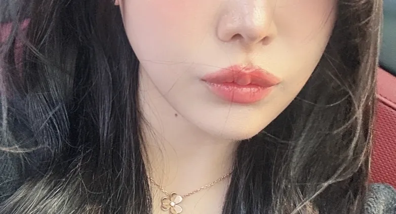 저 인중축소 했으요3