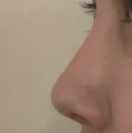 코 예쁘다고 병원에서 재수술하지말라는데 진짜그래요?