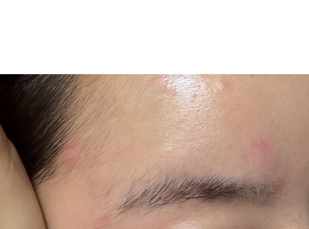 지루성 피부염? 이 이마에 눈썹라인에
