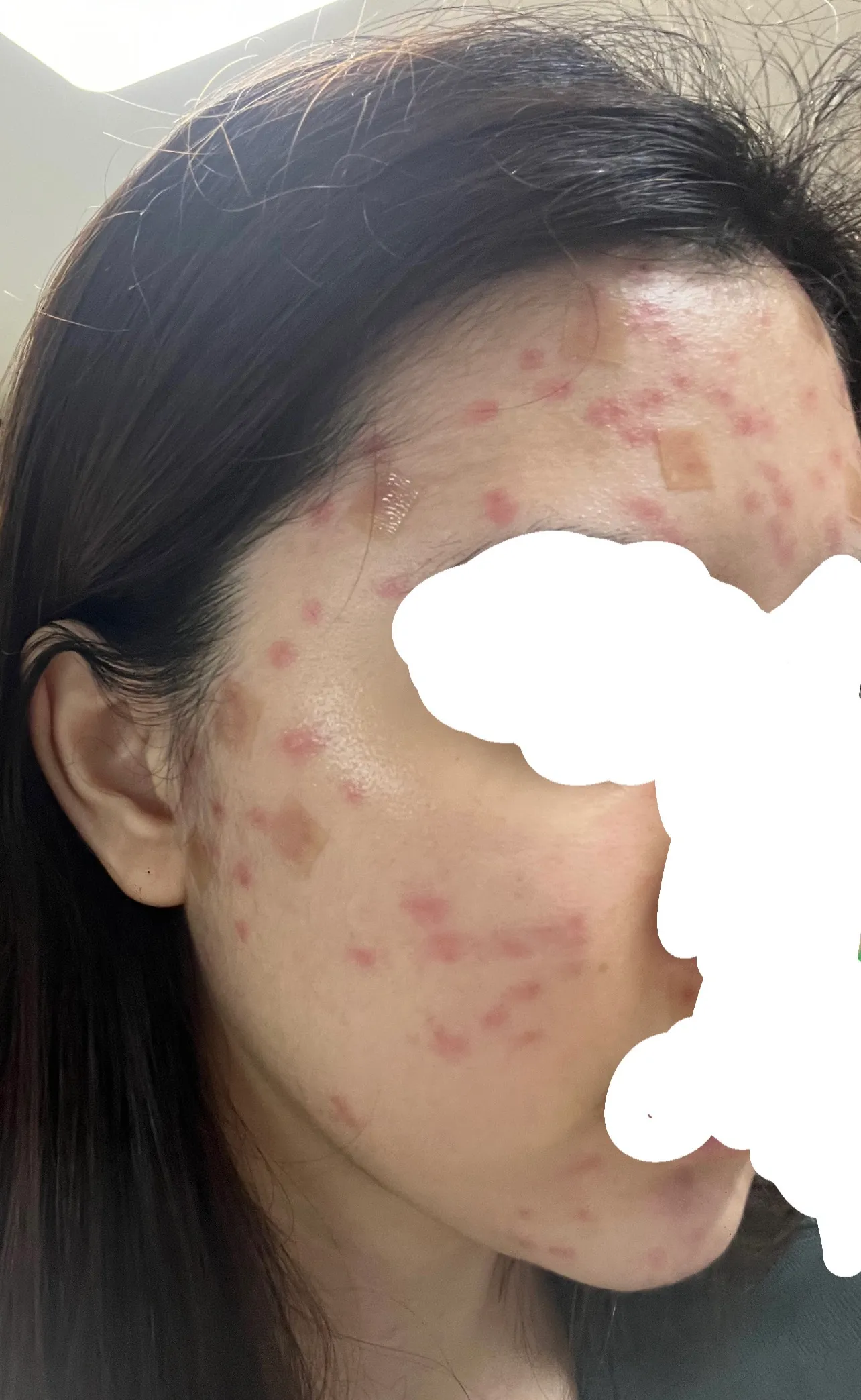 이거 여드름 압출 잘 못 하는거 맞죠?3