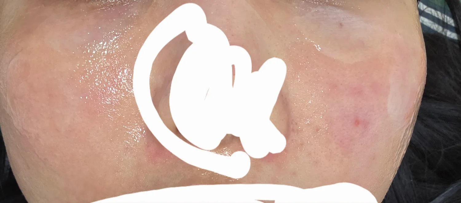 이거 지루성 피부염이에요?