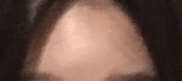 언니들 저 이마필러 녹이고 다시할까요