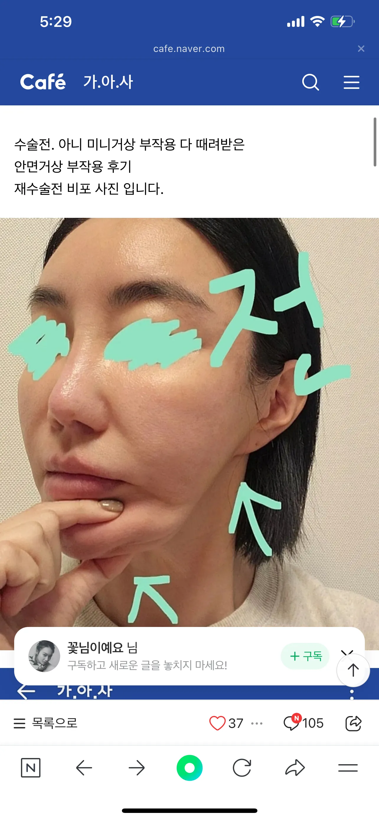 거상 부작용