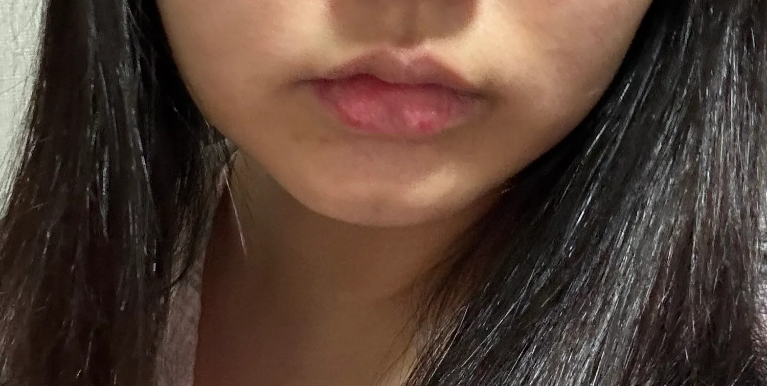 심부볼은 실리프팅밖에 답 없어요? 사진있음2