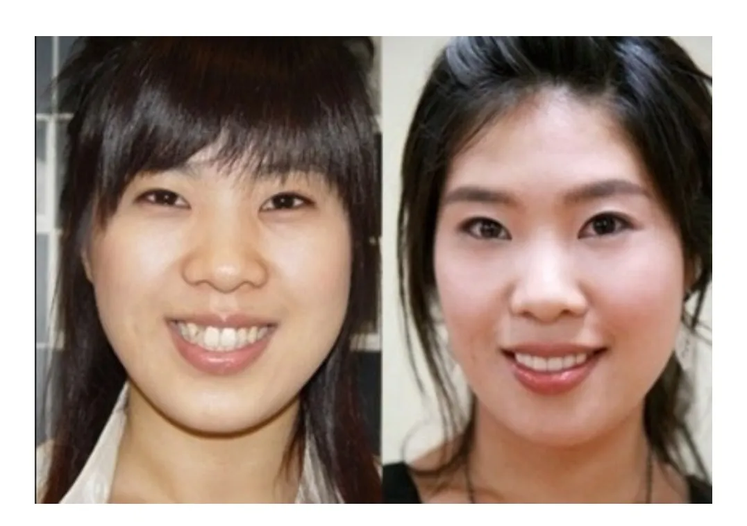 살짝 주걱턱에 사긱턱있는데 양악vs윤곽 댓글