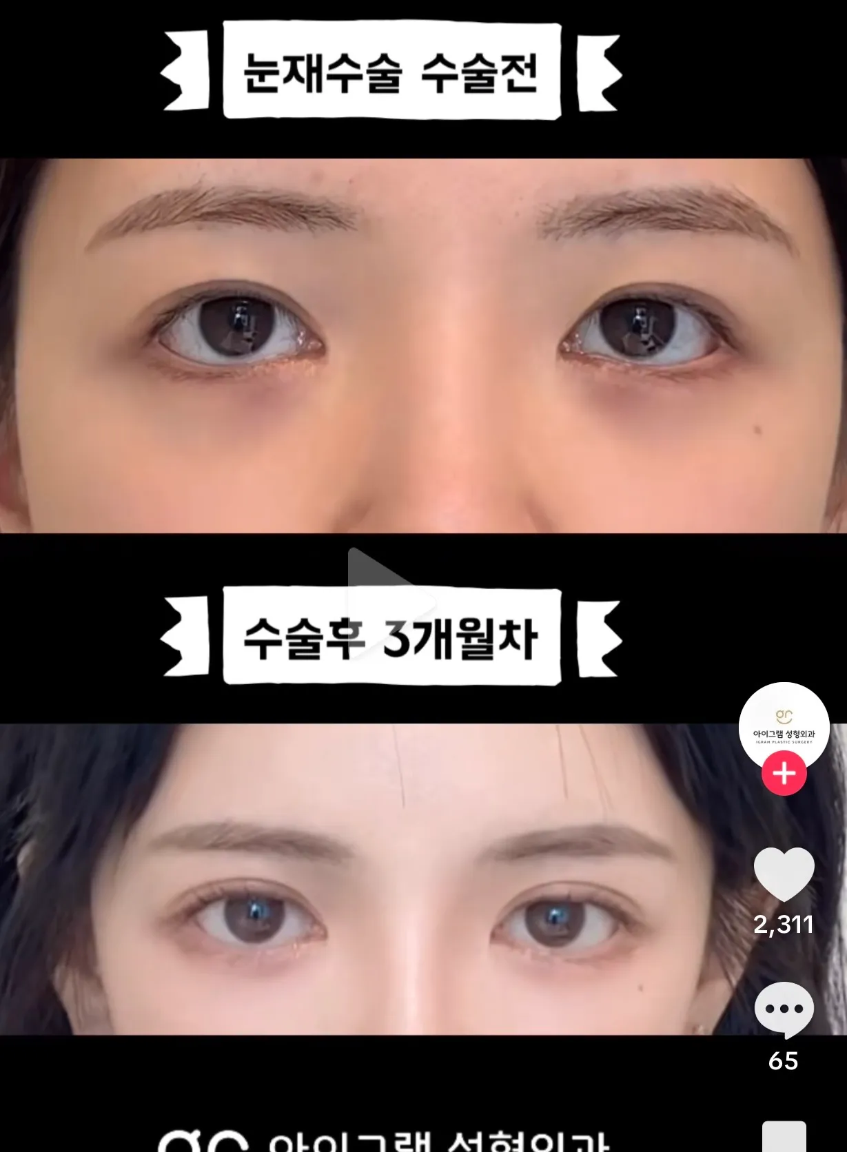 수술전 눈이 저랑 비슷한데