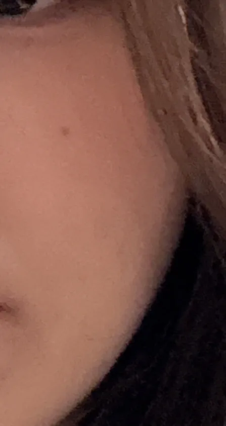 다낭성 있는데ㅠㅠ 부정출혈/여드름 갑자기 엄청나요