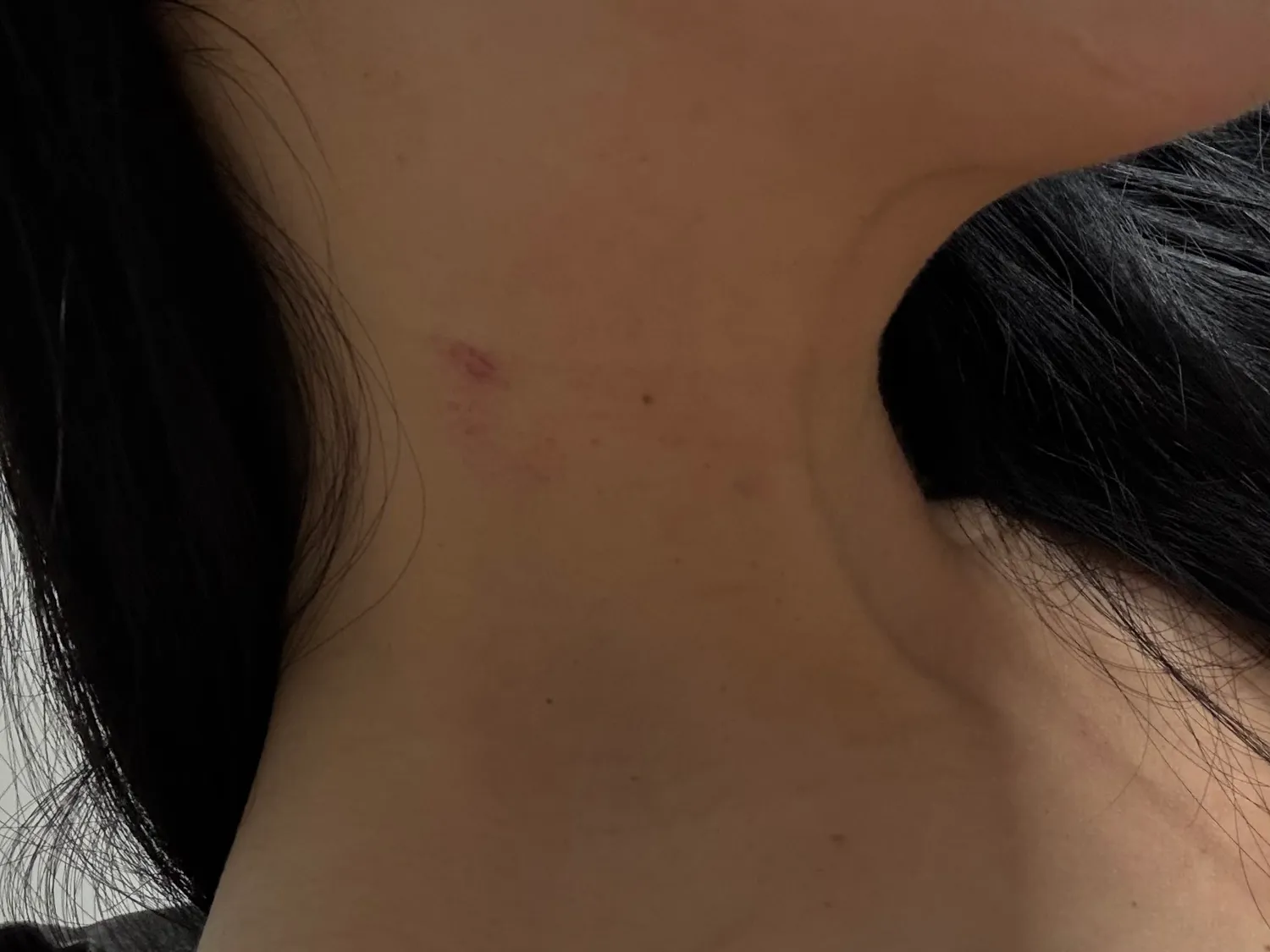 키스마크같나요..? 어케빨리없애나요..