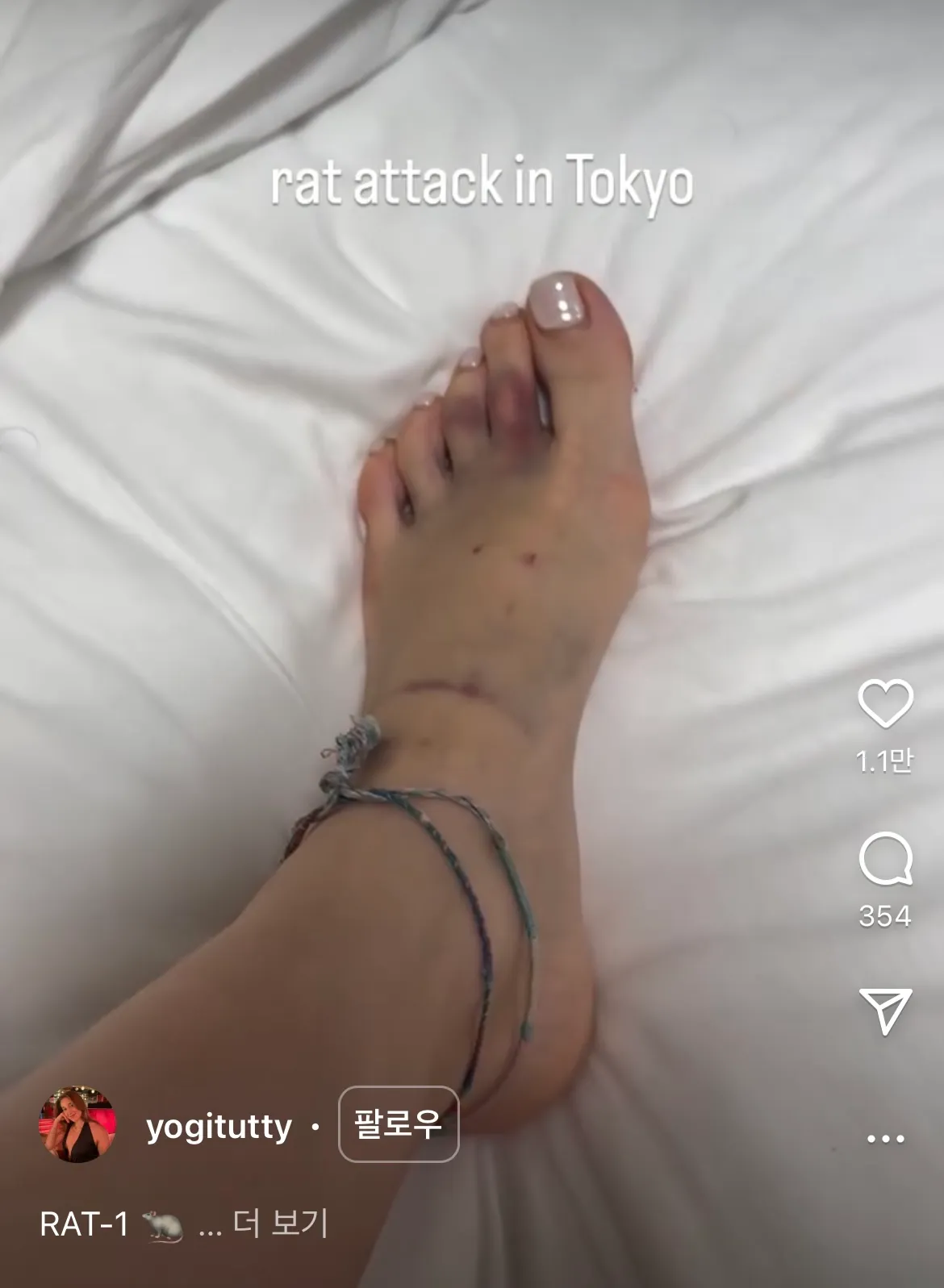혐주의) 도쿄 신주쿠 걷다가 쥐한테 물린 관광객3