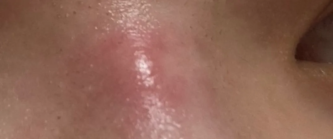 저 코실리콘부작용인가용?봐주세오ㅠㅜ흑흑