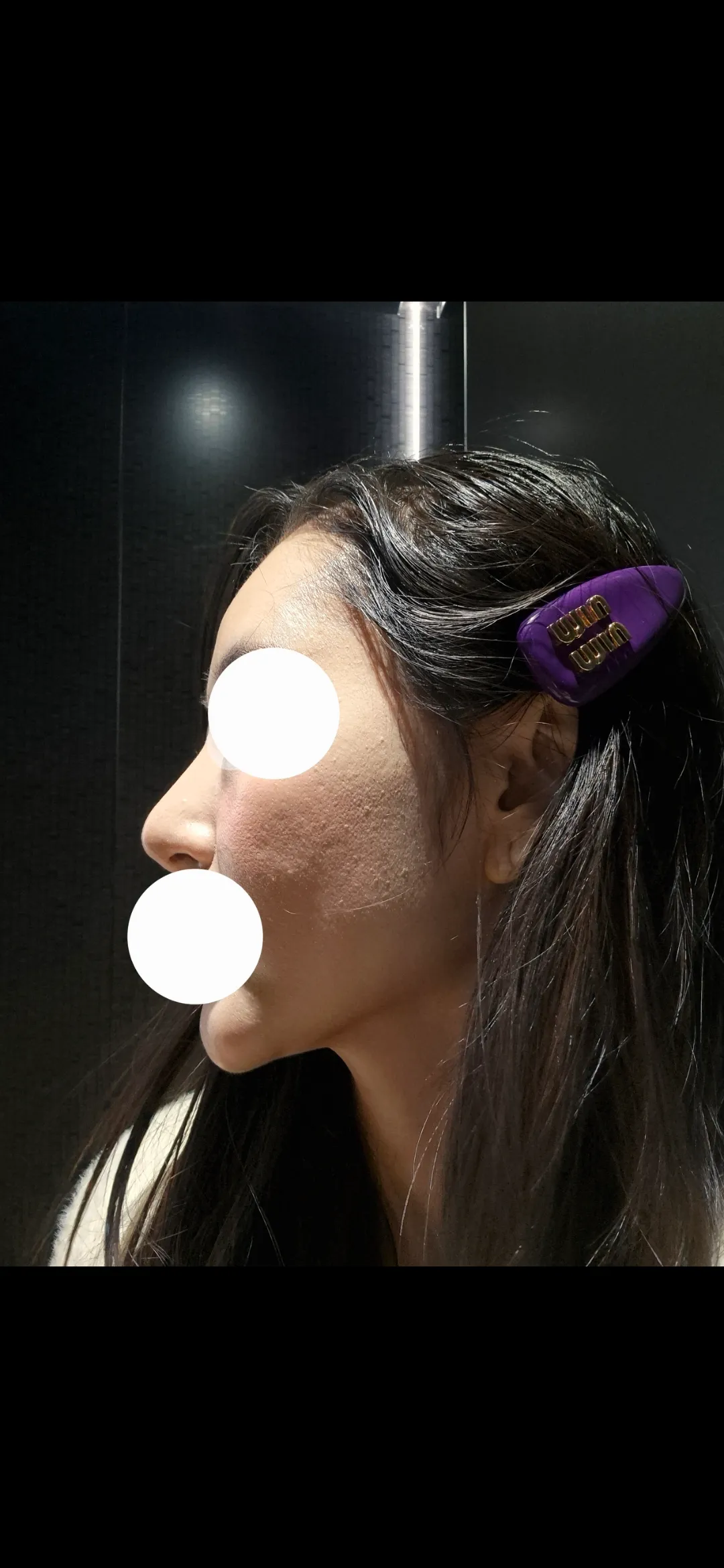 매달피부과다니는데도 피부가왜이렇죠...?2