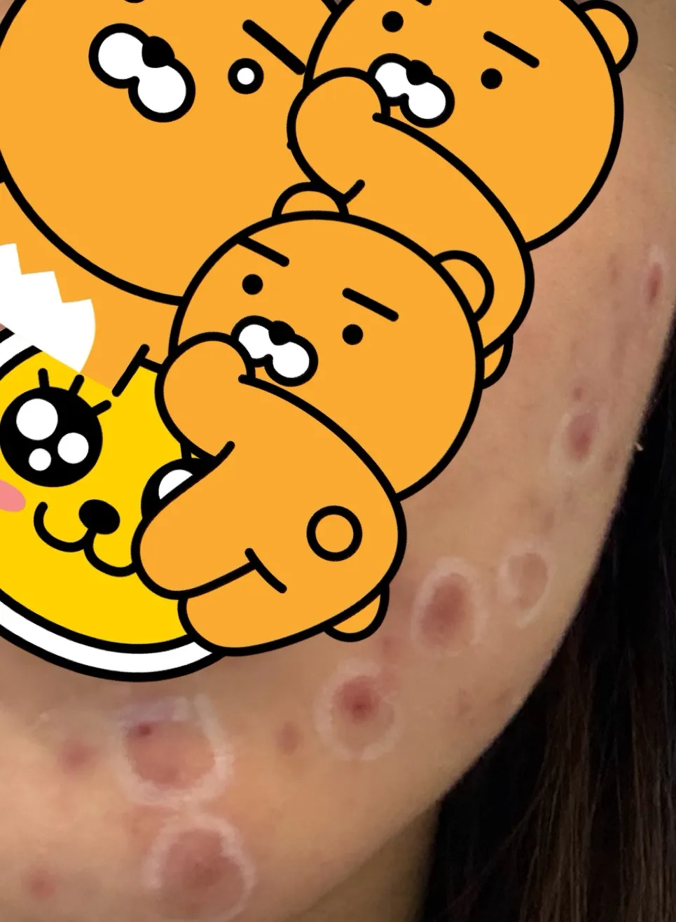 피부 결절염증 관리 어떻게 하는지 아시는분