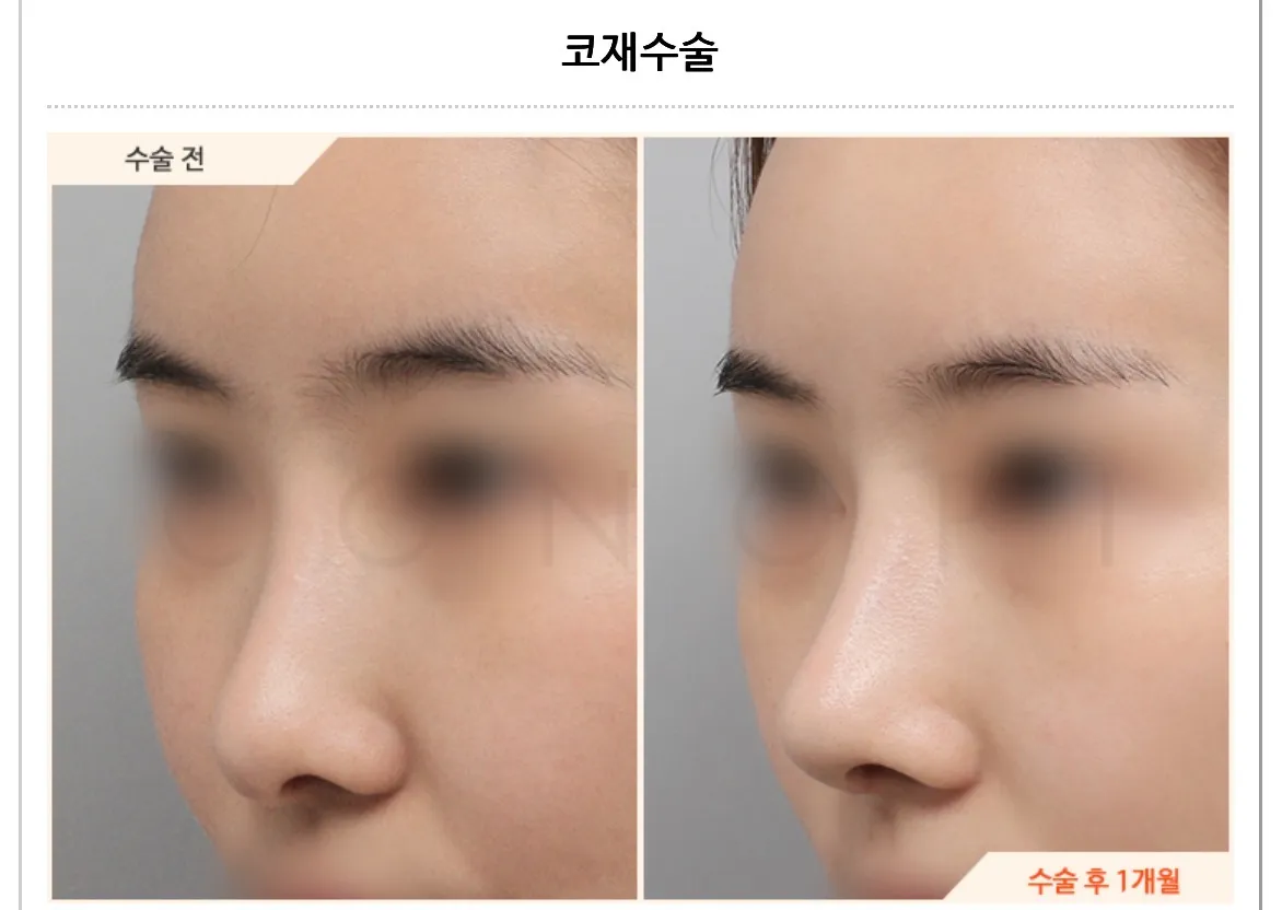 지금 첫수 코 맘에드는데 코끝만 너무 낮거든요..? 댓글