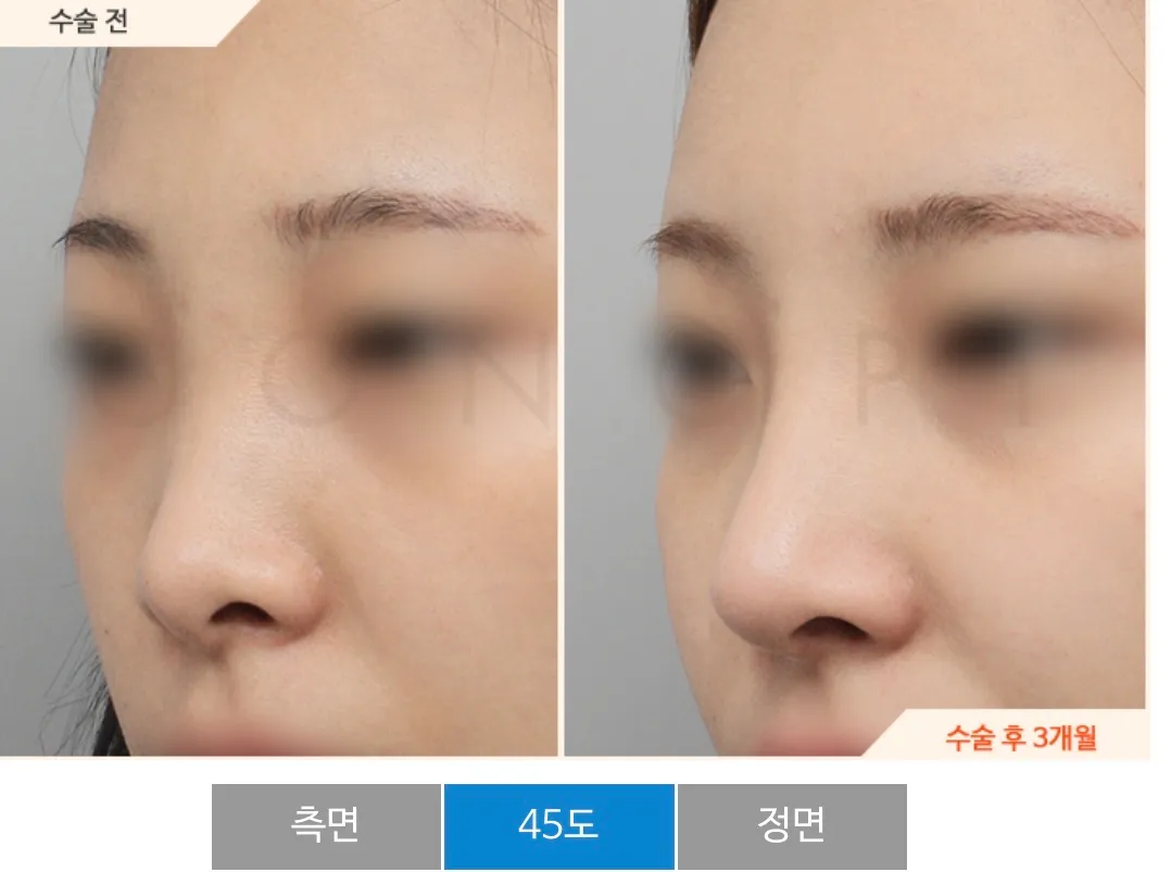 지금 첫수 코 맘에드는데 코끝만 너무 낮거든요..? 댓글 2