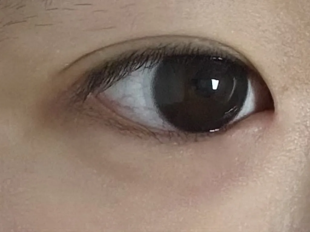 눈뒤밑트임 할까요말까용