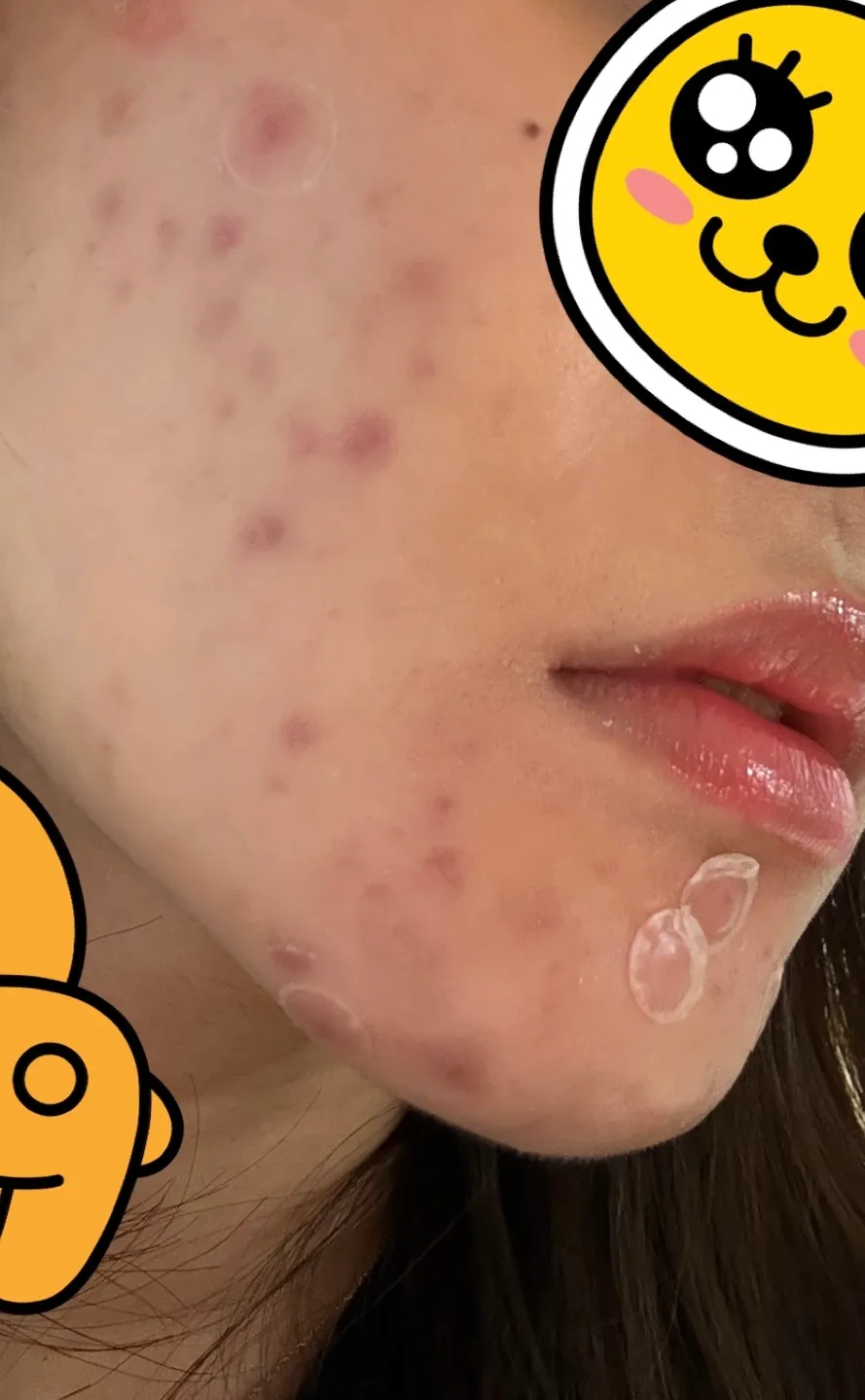 피부 개개개개개개뒤집어지면 보통 얼마나 쉬세요?
